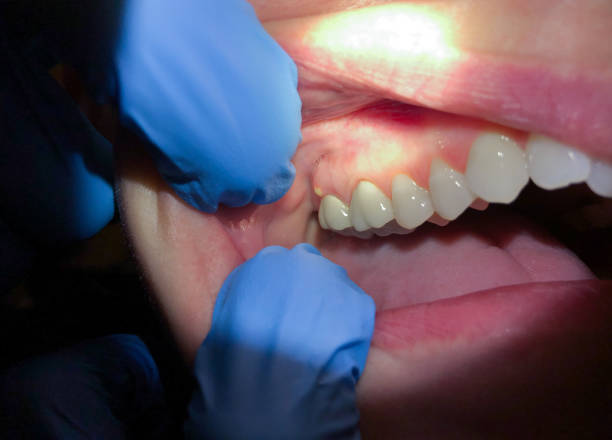 Best Emergency Care for Gum Disease in Lyman, WY