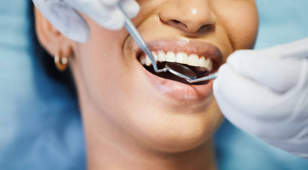 Best Knocked-Out Tooth (Avulsed Tooth) Treatment in Lyman, WY